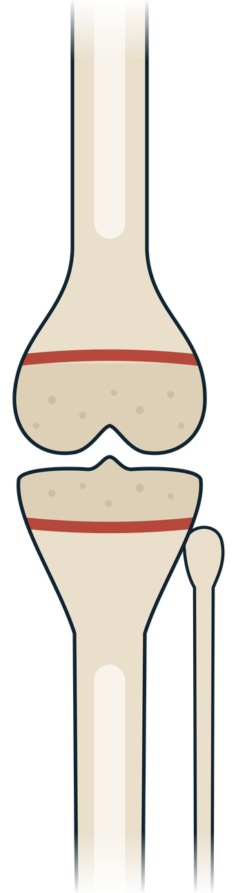 Schematic of a child's knee: femur above, tibia and fibula below, with a growth plate on each side of the joint